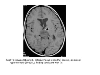 Diagnostic Imaging of Pineal Region Masses | PPT
