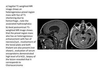 Diagnostic Imaging of Pineal Region Masses | PPT