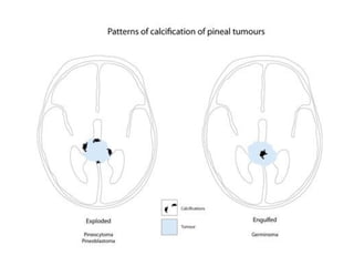 Diagnostic Imaging of Pineal Region Masses | PPT