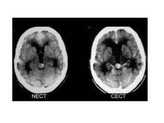 Diagnostic Imaging of Pineal Region Masses | PPT