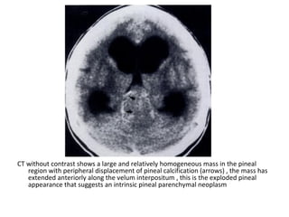 Diagnostic Imaging of Pineal Region Masses | PPT
