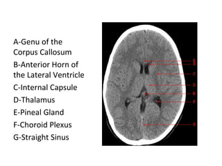 Diagnostic Imaging of Pineal Region Masses | PPT