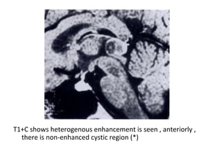 Diagnostic Imaging of Pineal Region Masses | PPT