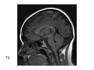 Diagnostic Imaging of Pineal Region Masses | PPT