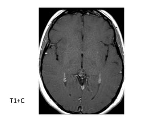 Diagnostic Imaging of Pineal Region Masses | PPT