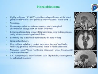  Highly malignant (WHO IV) primitive embryonal tumor of the pineal
gland and represents a true primitive neuroectodermal tumor (PNET).
 Young age.
 Hemorrhage and/or necrosis are common, and craniospinal
dissemination through the CSF occurs frequently.
 Extracranial metastatic spread of the tumor may occur to the peritoneal
cavity via the ventriculoperitoneal shunt.
 Extremely rare extracranial metastases to the bone or lung.
 Pineal anlage tumors.
 Hypercellular and closely packed patternless sheets of small cells,
mimicking primitive neuroectodermal tumor or medulloblastoma.
 Numerous Homer Wright rosettes and occasional Flexner-Wintersteiner
rosettes are observed.
 IHC: synaptophysin, neurofilaments, class III β-tubulin, chromogranin
A, and retinal S-antigen
Pinealoblastoma
 