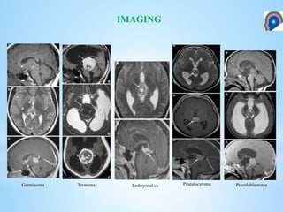 IMAGING
Germinoma Teratoma Embryonal ca Pinealocytoma Pinealoblastoma
 
