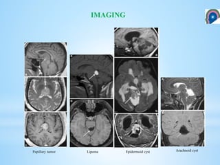 IMAGING
Lipoma Epidermoid cyst Arachnoid cystPapillary tumor
 