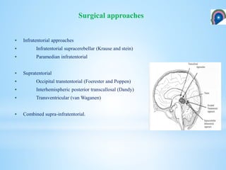  Infratentorial approaches
 Infratentorial supracerebellar (Krause and stein)
 Paramedian infratentorial
 Supratentorial
 Occipital transtentorial (Foerester and Poppen)
 Interhemispheric posterior transcallosal (Dandy)
 Transventricular (van Waganen)
 Combined supra-infratentorial.
Surgical approaches
 