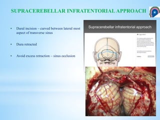  Dural incision – curved between lateral most
aspect of transverse sinus
 Dura retracted
 Avoid excess retraction – sinus occlusion
SUPRACEREBELLAR INFRATENTORIAL APPROACH
 