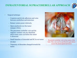 INFRATENTORIAL SUPRACEREBELLAR APPROACH
• Surgical technique
– Cauterize and divide adhesions and veins
between cerebellum and tentorium.
– Retract vermis poster inferiorly.
– Open arachnoid over the tumor
(opaque white),
– The precentral cerebellar vein and the
superior vermian vein are identified
and in most cases cut before the tumor
is dissected.
– Small branches of choroidal and SCA over tumor
divided.
– Trajectory of dissection changed towards the
tumor.
Precentral cerebellar vein in the center of the
field. This vein can be sacrificed to gain direct
access the pineal gland and lesion
 