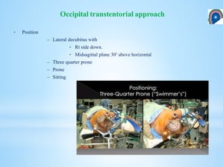 • Position
– Lateral decubitus with
• Rt side down.
• Midsagittal plane 30’ above horizontal
– Three quarter prone
– Prone
– Sitting
Occipital transtentorial approach
 
