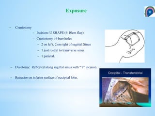 • Craniotomy
– Incision: U SHAPE (6-10cm flap)
– Craniotomy : 6 burr holes
– 2 on left, 2 on right of sagittal Sinus
– 1 just rostral to transverse sinus
– 1 parietal.
– Durotomy: Reﬂected along sagittal sinus with “T” incision.
– Retractor on inferior surface of occipital lobe.
Exposure
 