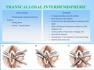 INDICATIONS
• Predominantly supratentorial tumor
• Position
• Sitting/ prone
• Lateral / 3 quarter prone.
TRANSCALLOSAL INTERHEMISPHERIC
SURGERY
– U shapes skin ﬂap across the midline
– Bone ﬂap across the midline
– Position of bone ﬂap depending on centering of the
tumor
– Wide craniotomy for alternate corridors to avoid
bridging veins
– Avoid sacriﬁce of more than 1 bridging vein
– Pericallosal retracted
– Callosotomy <2 cm centered over the tumor bulge.
– Identify deep veins early.
 