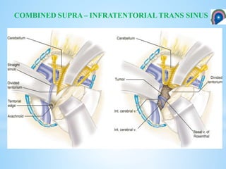 COMBINED SUPRA – INFRATENTORIAL TRANS SINUS
 