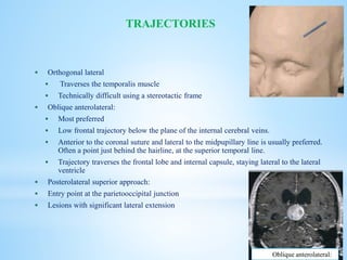  Orthogonal lateral
 Traverses the temporalis muscle
 Technically difficult using a stereotactic frame
 Oblique anterolateral:
 Most preferred
 Low frontal trajectory below the plane of the internal cerebral veins.
 Anterior to the coronal suture and lateral to the midpupillary line is usually preferred.
Often a point just behind the hairline, at the superior temporal line.
 Trajectory traverses the frontal lobe and internal capsule, staying lateral to the lateral
ventricle
 Posterolateral superior approach:
 Entry point at the parietooccipital junction
 Lesions with significant lateral extension
TRAJECTORIES
Oblique anterolateral:
 