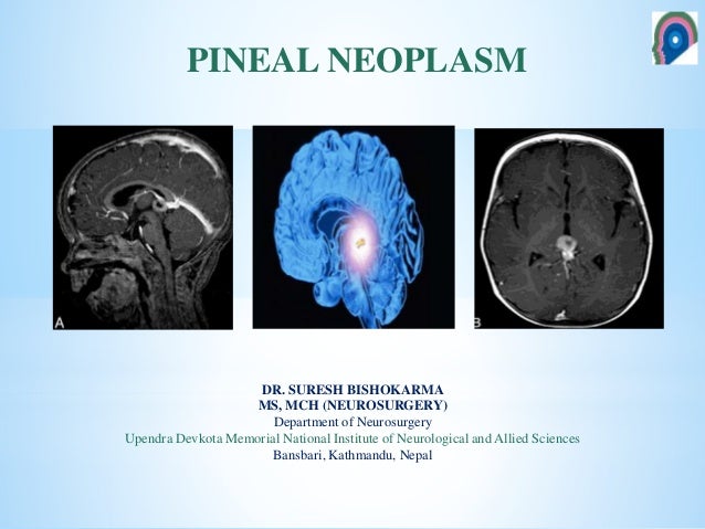 Approach To Pineal Tumor