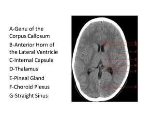 A-Genu of the
Corpus Callosum
B-Anterior Horn of
the Lateral Ventricle
C-Internal Capsule
D-Thalamus
E-Pineal Gland
F-Choroid Plexus
G-Straight Sinus
 