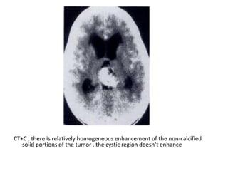 CT+C , there is relatively homogeneous enhancement of the non-calcified
solid portions of the tumor , the cystic region doesn’t enhance
 