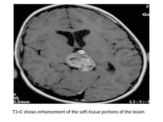 T1+C shows enhancement of the soft-tissue portions of the lesion
 