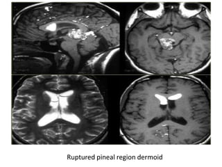 Ruptured pineal region dermoid
 
