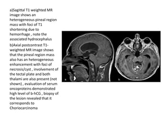 a)Sagittal T1 weighted MR
image shows an
heterogeneous pineal region
mass with foci of T1
shortening due to
hemorrhage , note the
associated hydrocephalus
b)Axial postcontrast T1-
weighted MR image shows
that the pineal region mass
also has an heterogeneous
enhancement with foci of
necrosis/cyst , involvement of
the tectal plate and both
thalami are also present (not
shown) , evaluation of serum
oncoproteins demonstrated
high level of b-hCG , biopsy of
the lesion revealed that it
corresponds to
Choriocarcinoma
 