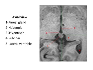 Axial view
1-Pineal gland
2-Habenula
3-3rd ventricle
4-Pulvinar
5-Lateral ventricle
 