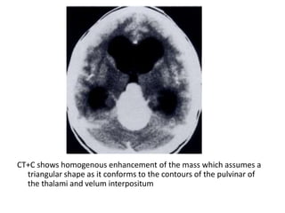 CT+C shows homogenous enhancement of the mass which assumes a
triangular shape as it conforms to the contours of the pulvinar of
the thalami and velum interpositum
 