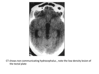 CT shows non-communicating hydrocephalus , note the low density lesion of
the tectal plate
 