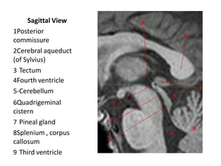 Sagittal View
1Posterior
commissure
2Cerebral aqueduct
(of Sylvius)
3 Tectum
4Fourth ventricle
5-Cerebellum
6Quadrigeminal
cistern
7 Pineal gland
8Splenium , corpus
callosum
9 Third ventricle
 