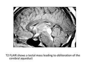 T2 FLAIR shows a tectal mass leading to obliteration of the
cerebral aqueduct
 