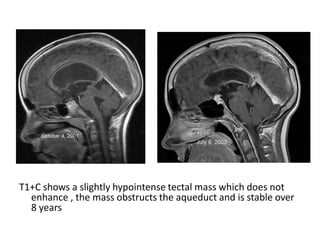 T1+C shows a slightly hypointense tectal mass which does not
enhance , the mass obstructs the aqueduct and is stable over
8 years
 