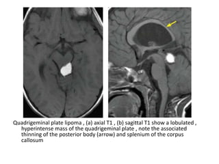 Quadrigeminal plate lipoma , (a) axial T1 , (b) sagittal T1 show a lobulated ,
hyperintense mass of the quadrigeminal plate , note the associated
thinning of the posterior body (arrow) and splenium of the corpus
callosum
 
