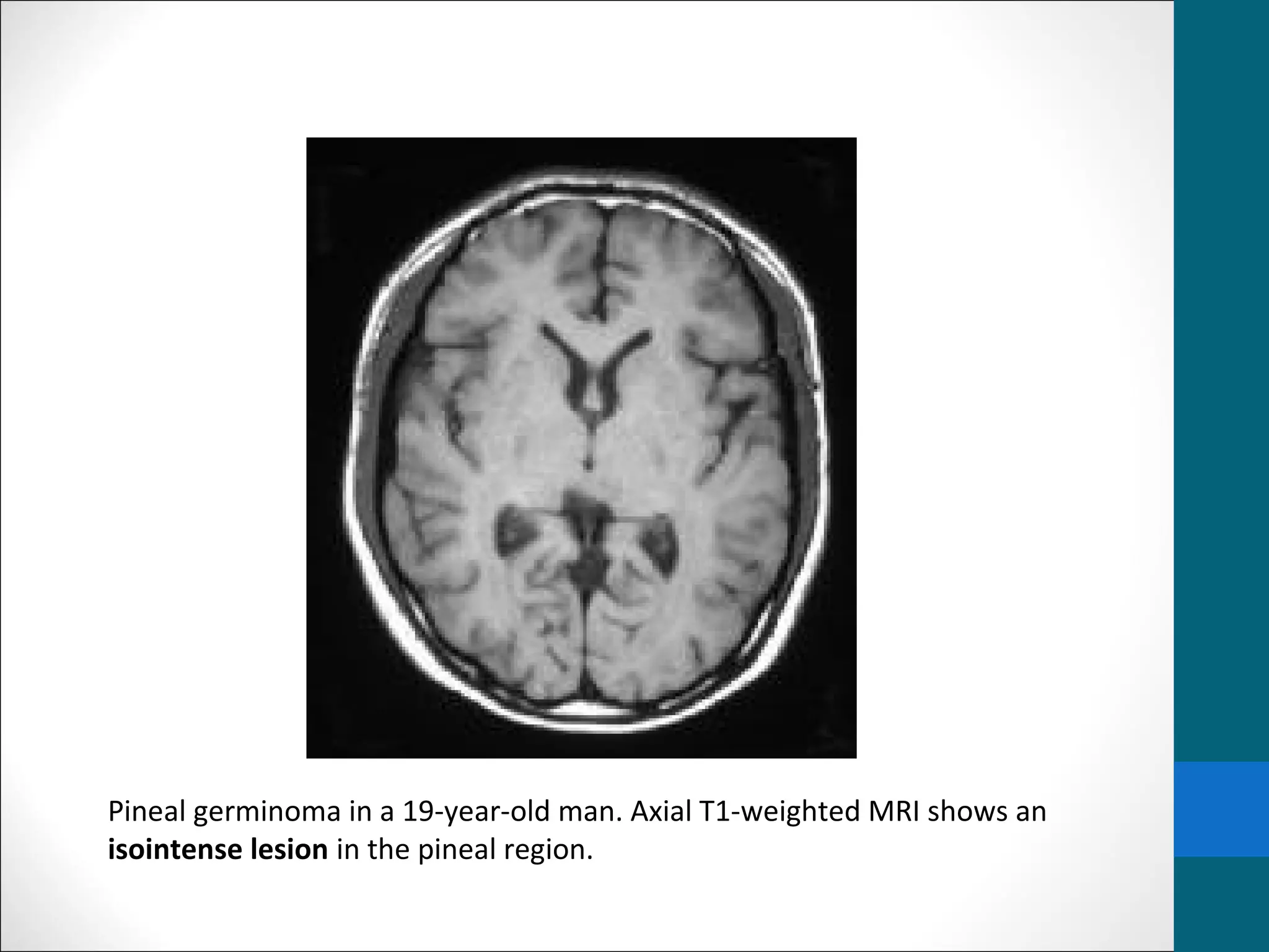 Pineal gland tumors | PPT