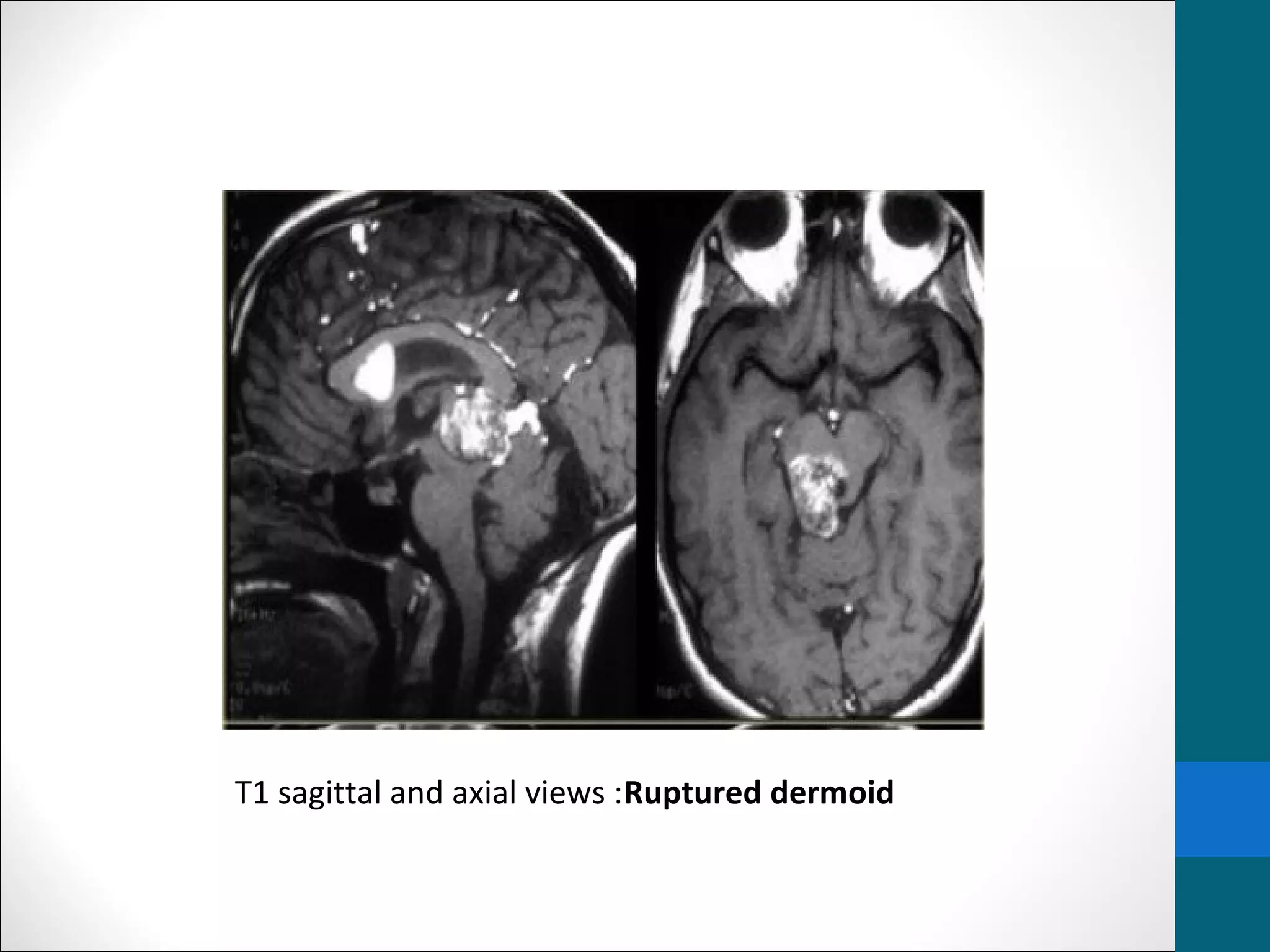 Pineal gland tumors | PPT