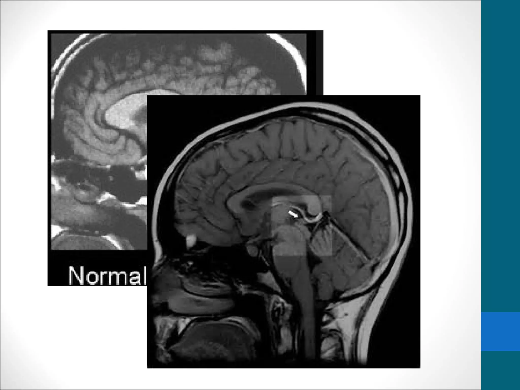 Pineal gland tumors | PPT