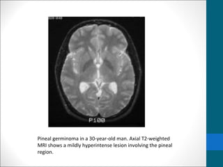 Pineal germinoma in a 30-year-old man. Axial T2-weighted 
MRI shows a mildly hyperintense lesion involving the pineal 
region. 
 