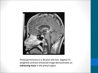 Pineal germinoma in a 30-year-old man. Sagittal T1- 
weighted contrast-enhanced image demonstrates an 
enhancing mass in the pineal region. 
 