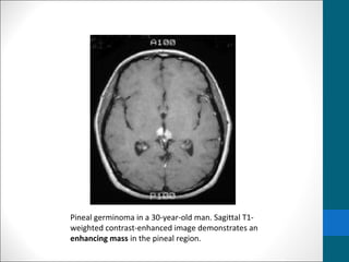 Pineal germinoma in a 30-year-old man. Sagittal T1- 
weighted contrast-enhanced image demonstrates an 
enhancing mass in the pineal region. 
 