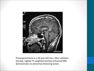 Pineal germinoma in a 30-year-old man. After radiation 
therapy, sagittal T1-weighted contrast-enhanced MRI 
demonstrates no abnormal enhancing tumor. 
 
