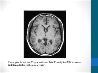 Pineal germinoma in a 19-year-old man. Axial T1-weighted MRI shows an 
isointense lesion in the pineal region. 
 