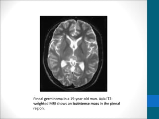 Pineal germinoma in a 19-year-old man. Axial T2- 
weighted MRI shows an isointense mass in the pineal 
region. 
 