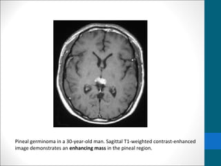 Pineal germinoma in a 30-year-old man. Sagittal T1-weighted contrast-enhanced 
image demonstrates an enhancing mass in the pineal region. 
 