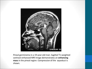 Pineal germinoma in a 19-year-old man. Sagittal T1-weighted 
contrast-enhanced MRI image demonstrates an enhancing 
mass in the pineal region. Compression of the aqueduct is 
shown. 
 