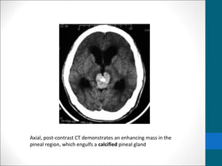 Axial, post-contrast CT demonstrates an enhancing mass in the 
pineal region, which engulfs a calcified pineal gland 
 