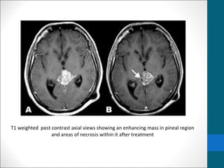 T1 weighted post contrast axial views showing an enhancing mass in pineal region 
and areas of necrosis within it after treatment 
 