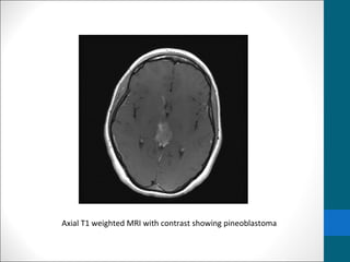 Axial T1 weighted MRI with contrast showing pineoblastoma 
 