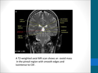 A T2-weighted axial MR scan shows an ovoid mass 
in the pineal region with smooth edges and 
isointense to CSF. 
 