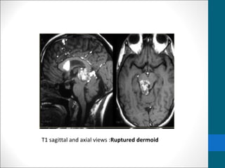 T1 sagittal and axial views :Ruptured dermoid 
 