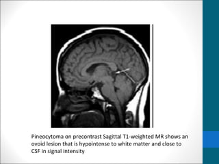 Pineocytoma on precontrast Sagittal T1-weighted MR shows an 
ovoid lesion that is hypointense to white matter and close to 
CSF in signal intensity 
 